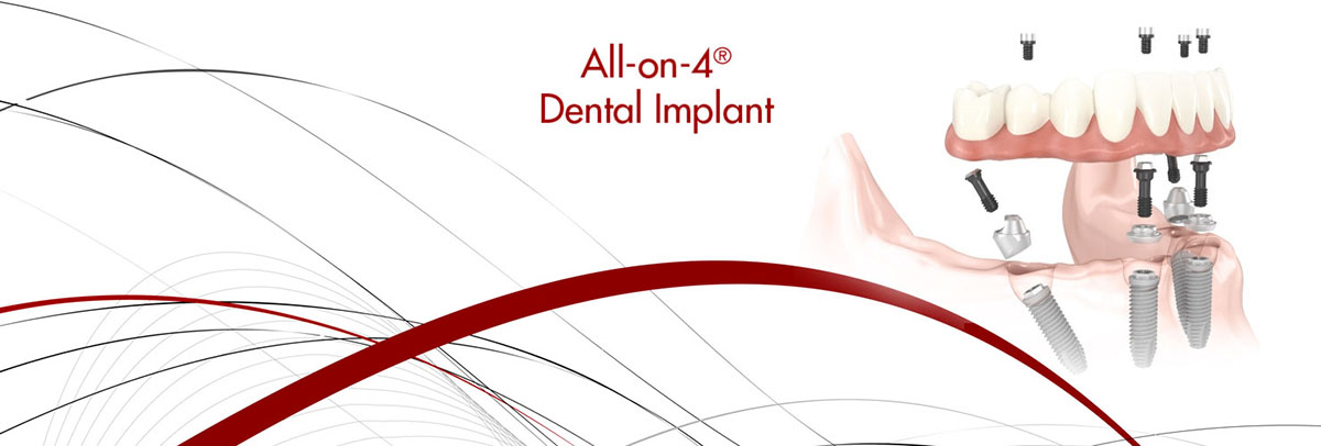 Boca Raton All-on-4 Dental Implants