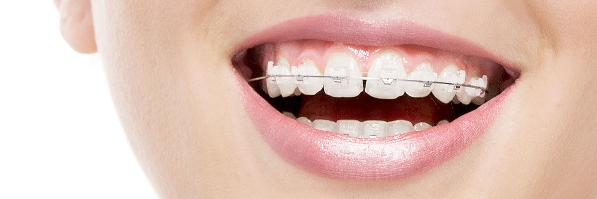 Boca Raton Invisible Orthodontics