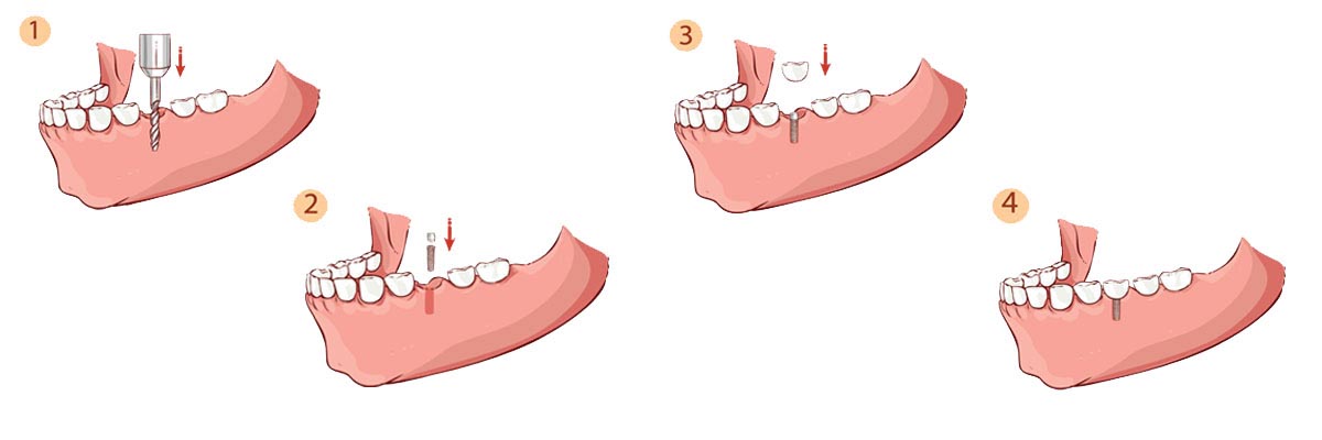 Boca Raton The Dental Implant Procedure