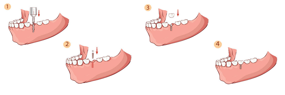 Boca Raton Dental Implant Restoration