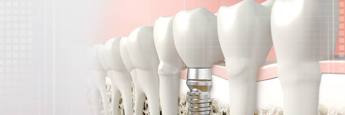 Boca Raton Dental Prosthetics