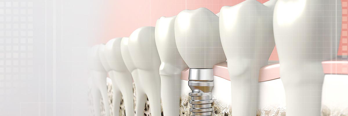 Boca Raton Implant Dentist