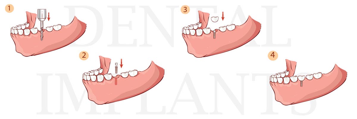 Boca Raton The Difference Between Dental Implants and Mini Dental Implants