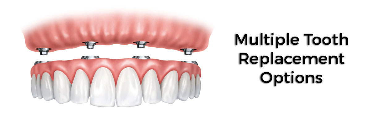Boca Raton Multiple Teeth Replacement Options