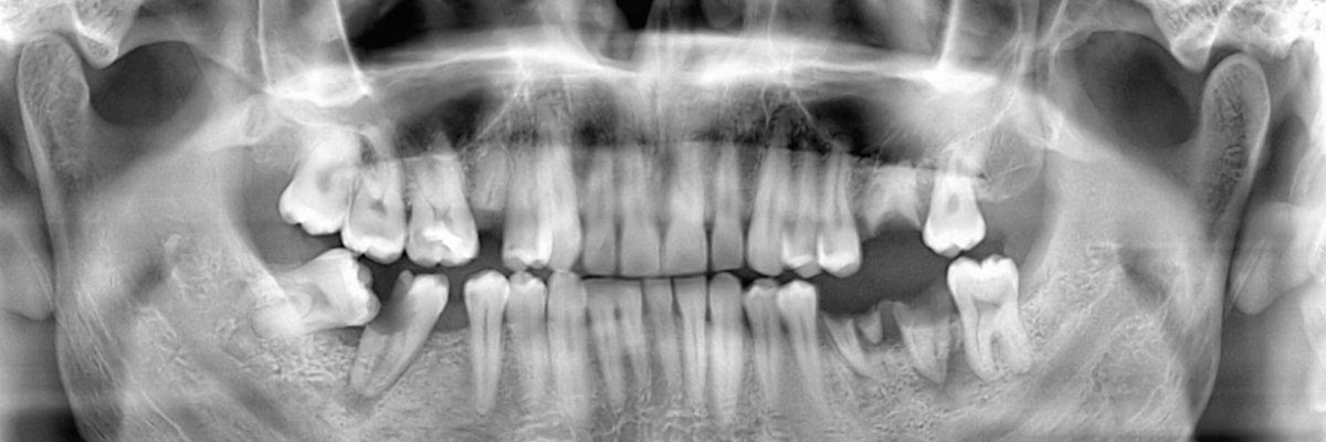 Boca Raton Options for Replacing Missing Teeth