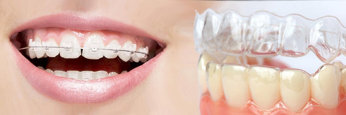 Boca Raton Which is Better Invisalign or Braces