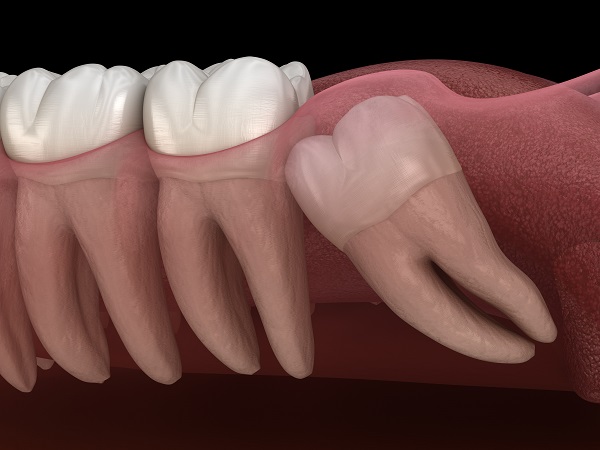 wisdom tooth extraction Boca Raton, FL